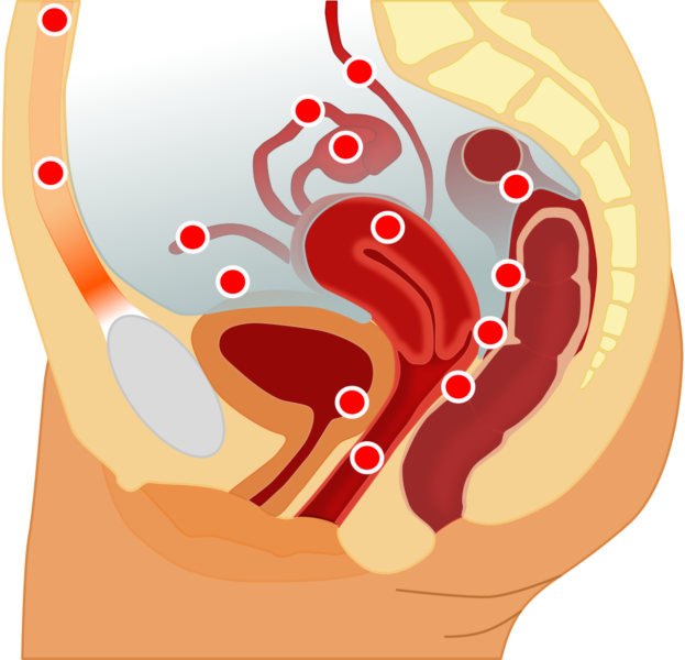 Platser i kroppen där endometrios lokaliserats.