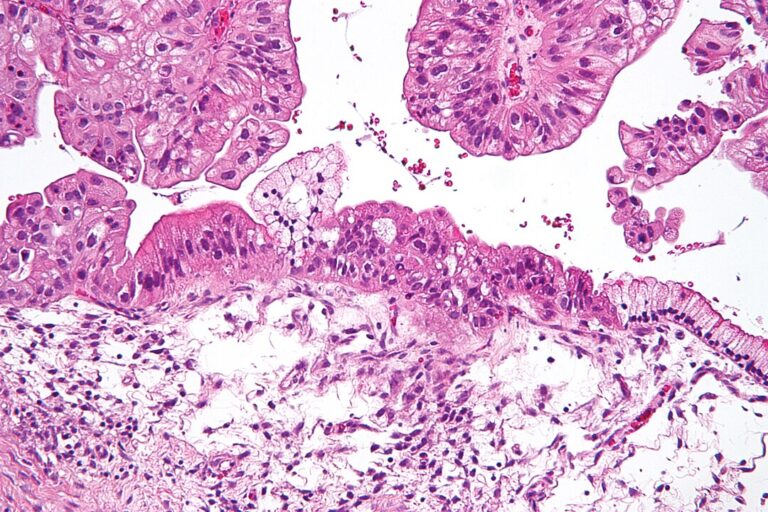 äggstockscancer